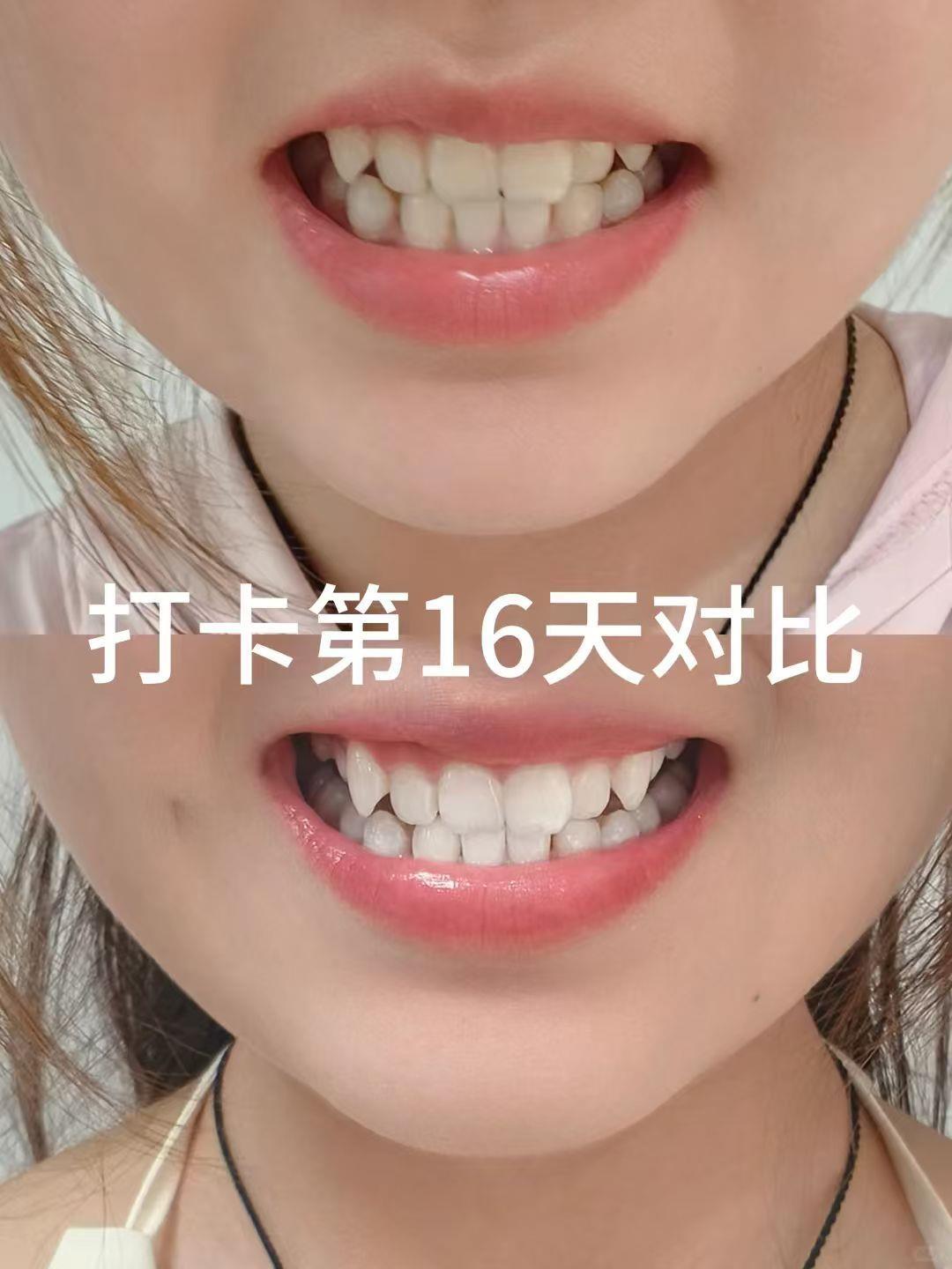纳美益生菌小苏打牙膏5支+2支牙刷 29.9元 - 86线报