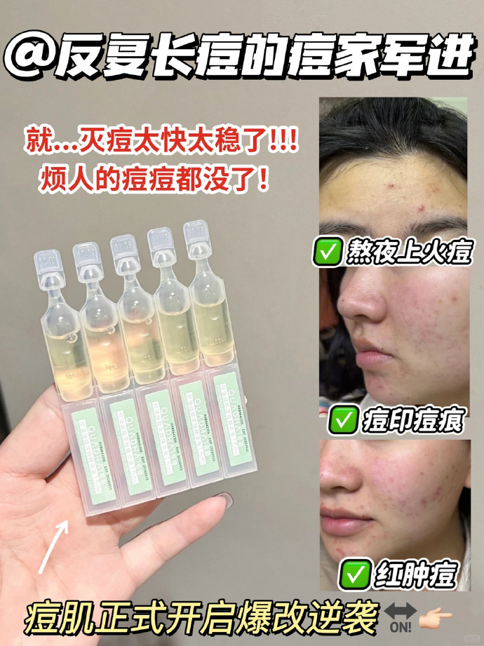 夸迪战痘次抛30支 51.9元 - 线报酷 夸迪战痘次抛30支 51.9元 - 线报酷