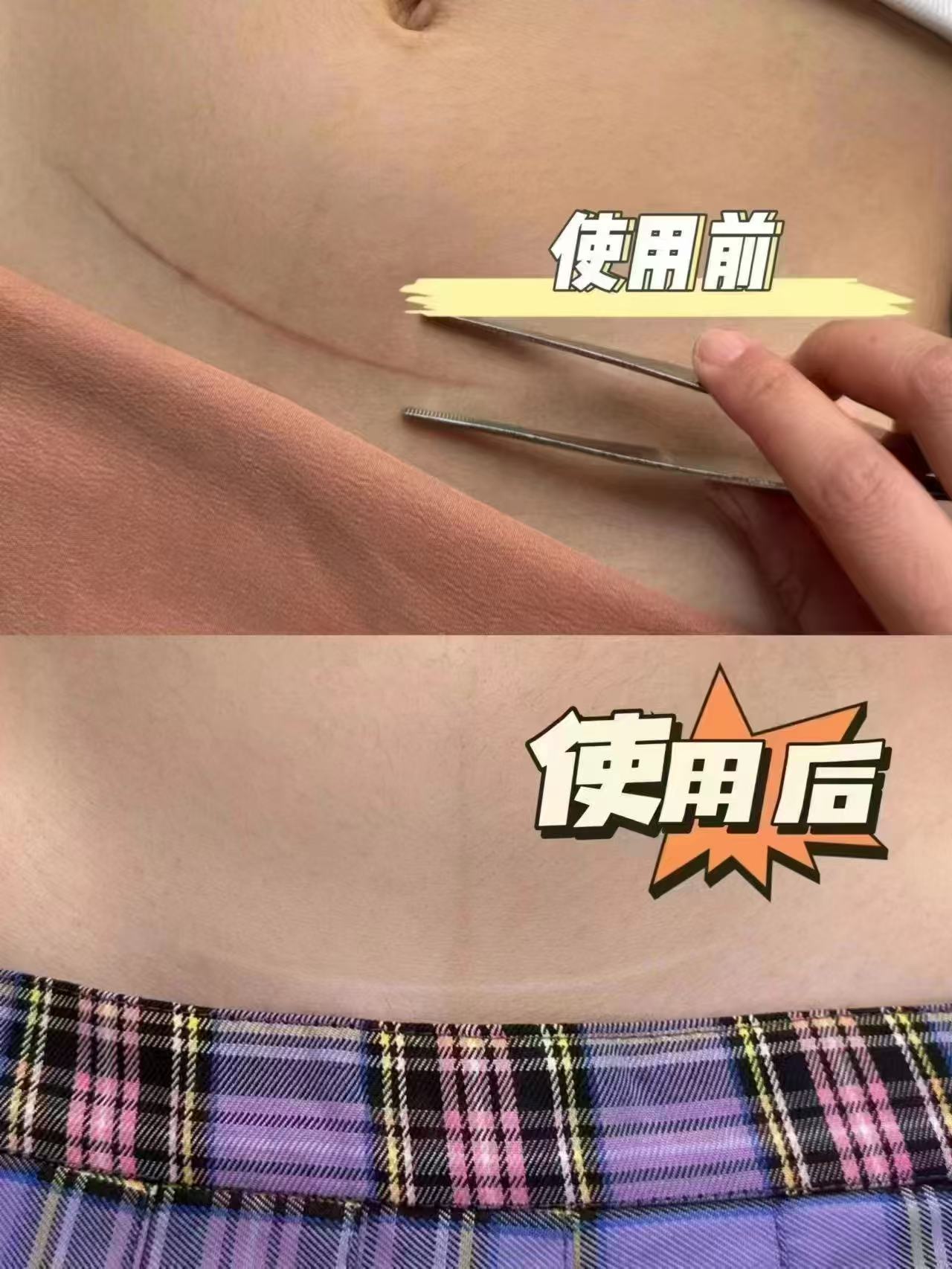 疤克修复医用凝胶祛疤膏15g 201元 - 86线报 疤克修复医用凝胶祛疤膏15g 201元 - 86线报