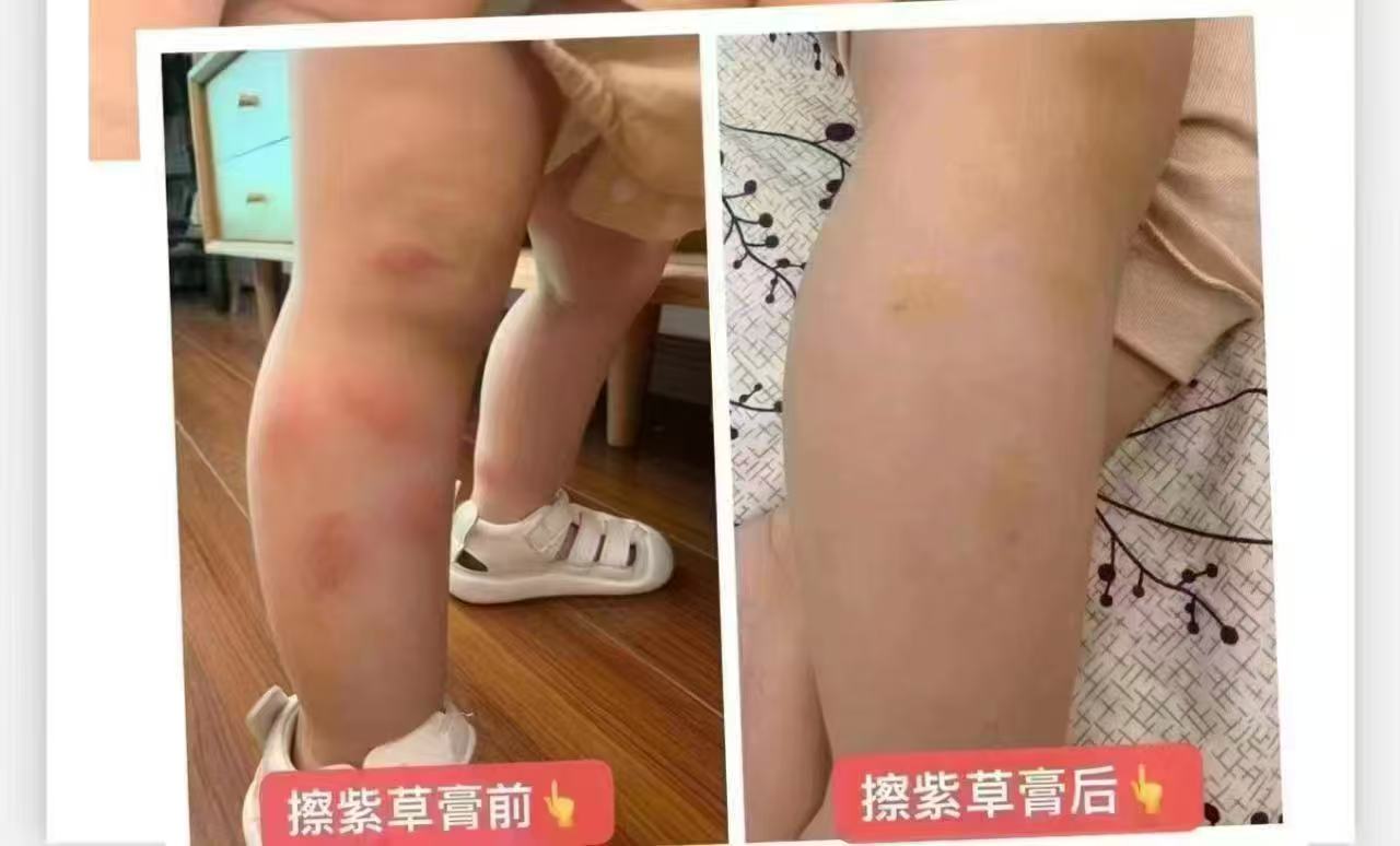 贝德美紫草膏拍1发2支共19元 - 86线报
