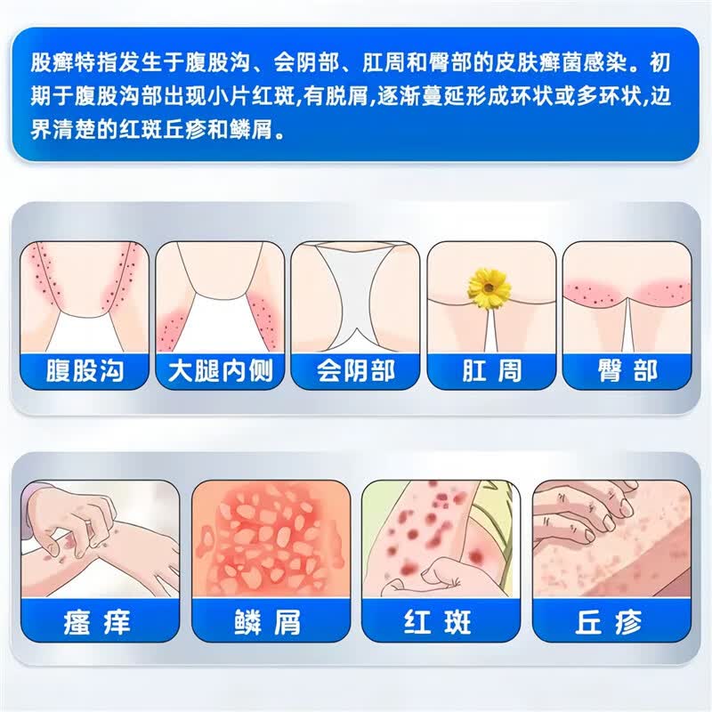 三九必无忧盐酸特比萘芬凝胶乳膏20克 9.9元 - 86线报